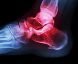 Achilles tendon repair