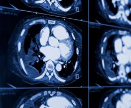 MRI scan: Virtual colonoscopy