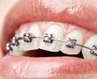 Bridge (12 tooth bridge, 6 implants)